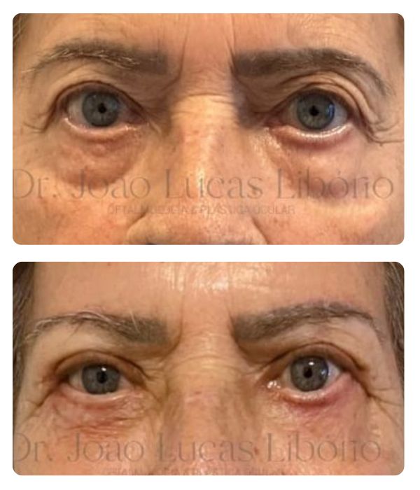 dr joao lucas liborio cirurgia de palpebras